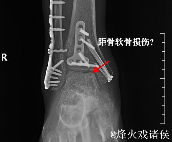 加福德:右脚踝感觉好多了,这是长时间以来感觉最好的一次 加福德:右脚踝感觉好多了,这是长时间以来感觉最好的一次